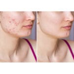 Dr. Belmeur Spot Care Ampoule 22ml – beruhigendes Serum mit Panthenol, Beta-Glucan, Chaga-Pilz und Teebaumöl gegen Unreinheiten und Rötungen. Abbildung vorher / nachher Bild.